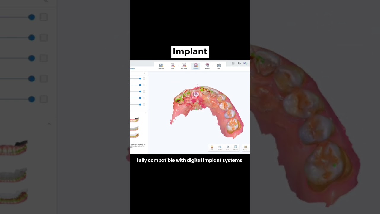 What COXO DL-300P Intraoral Scanner Can Scan?(Real Examples)