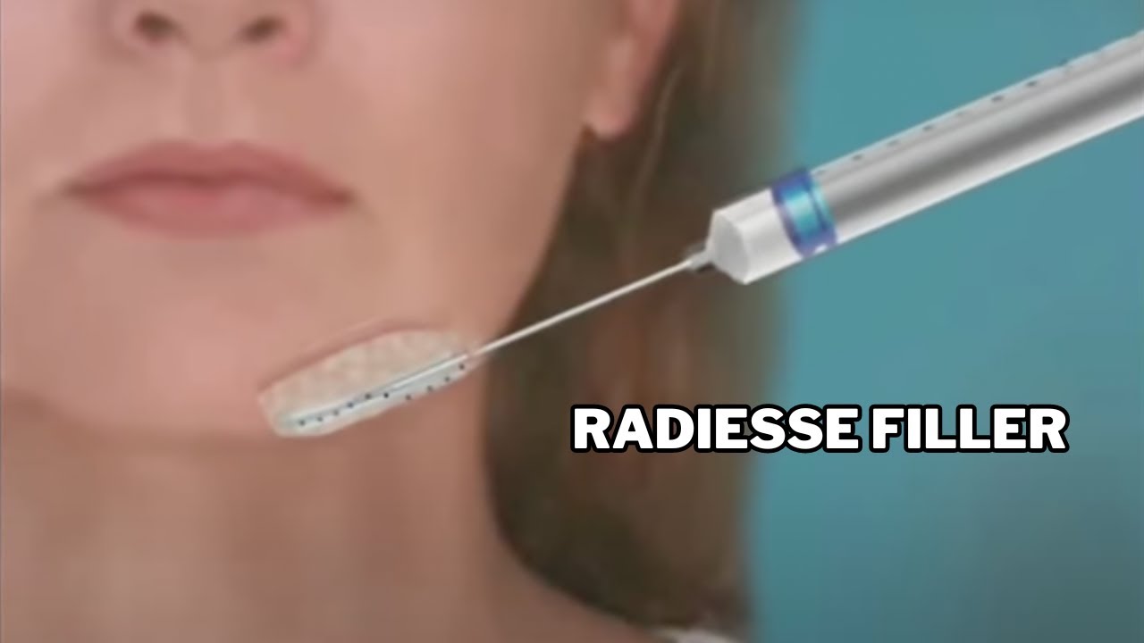 Radiesse Filler per Lifting non Chirurgico