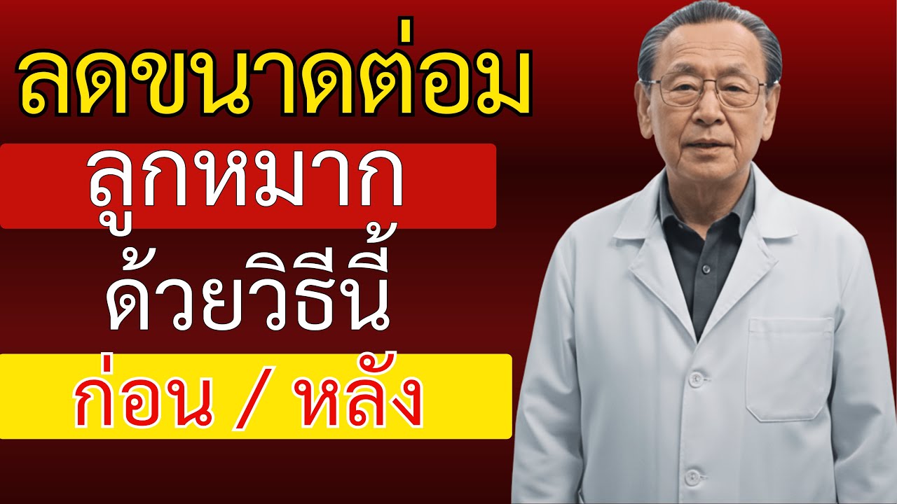 ในฐานะแพทย์ทางเดินปัสสาวะ ผมขอบอกตรงๆ: นี่คือวิธีที่ดีที่สุดในการป้องกันต่อมลูกหมากโต