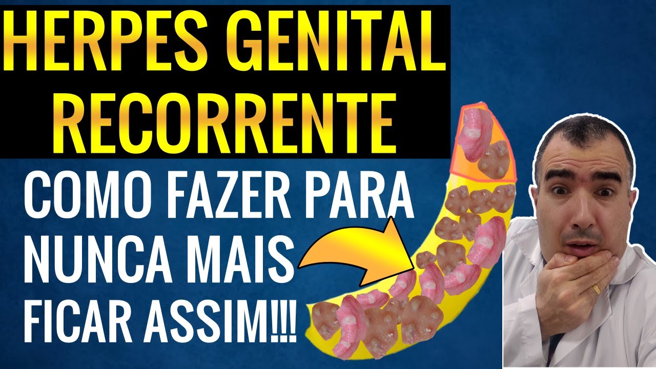 HERPES GENITAL RECORRENTE: como fazer para que não volte mais!!!