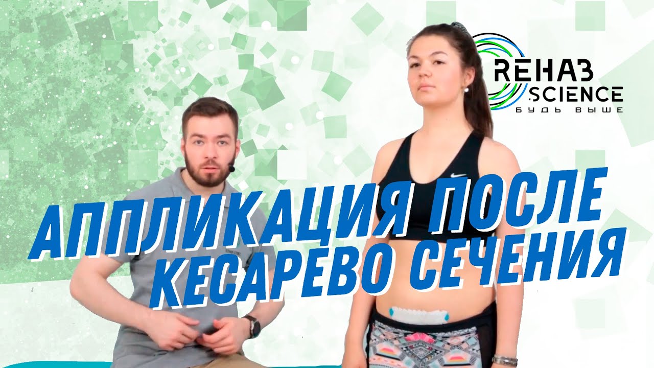Кинезиотейпирование после кесарево сечения. Кинезиотейпирование живота.