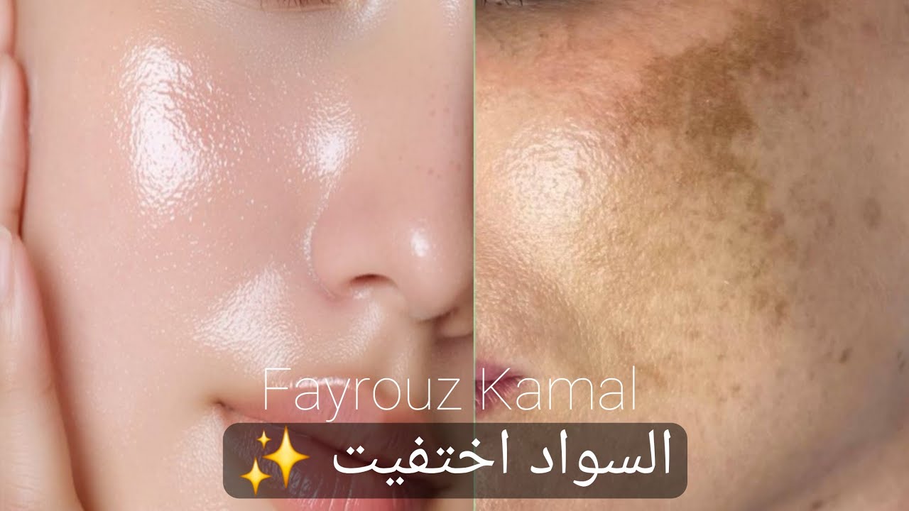 أقوى المكونات التي تعالج المسام وتفتح لون الجلد في 3 أيام.‼️✨️