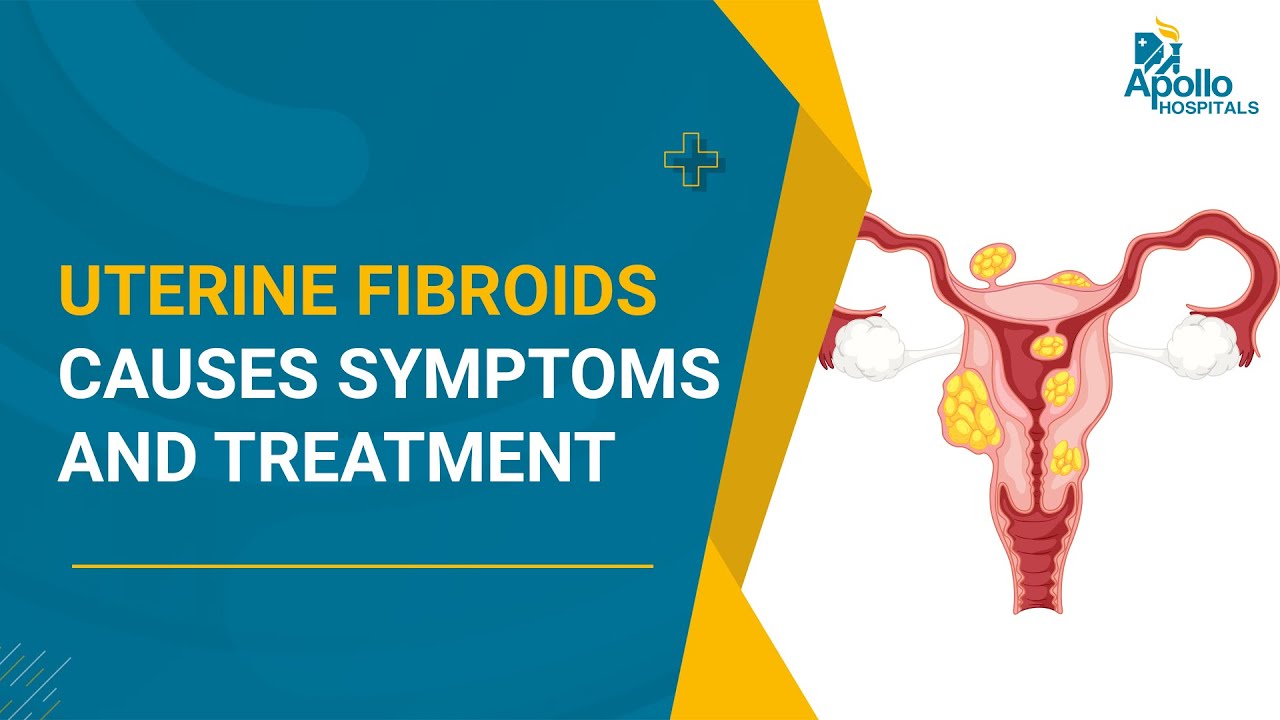 Uterine Fibroids Causes, Symptoms and Treatment Options | Robotic Surgery
