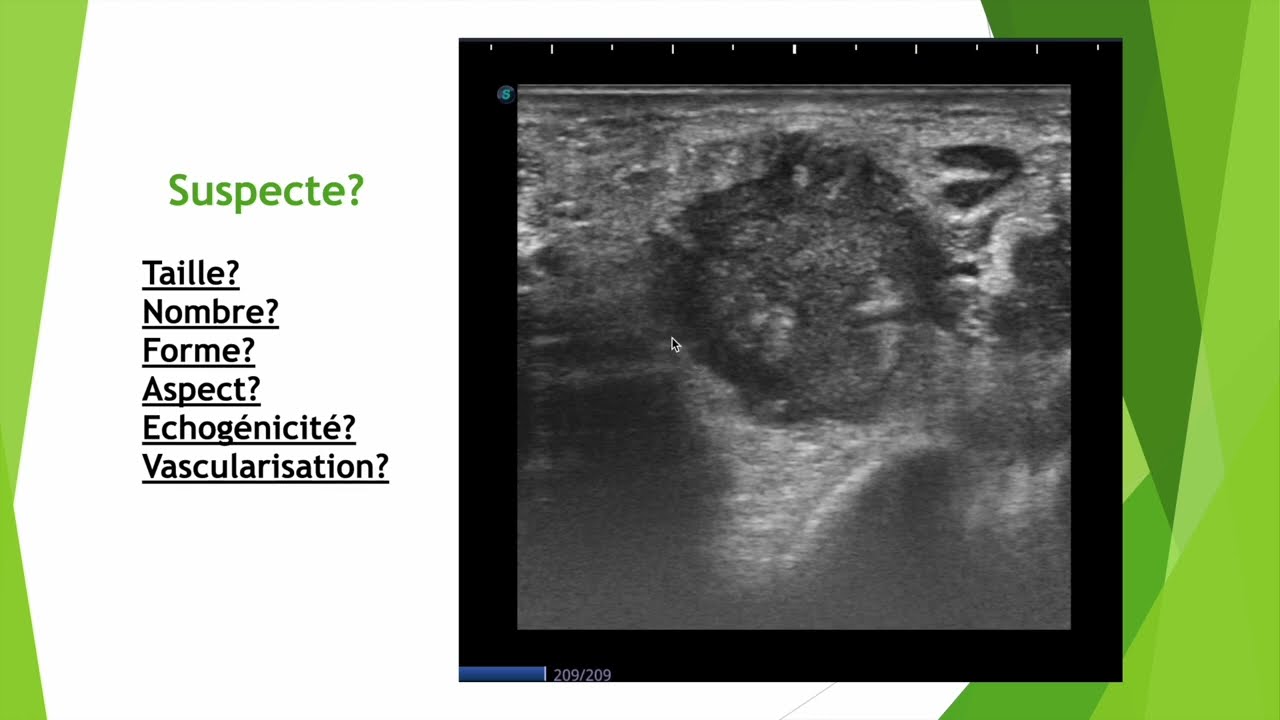 Les 6 points clés d'une adénopathie suspecte en échographie