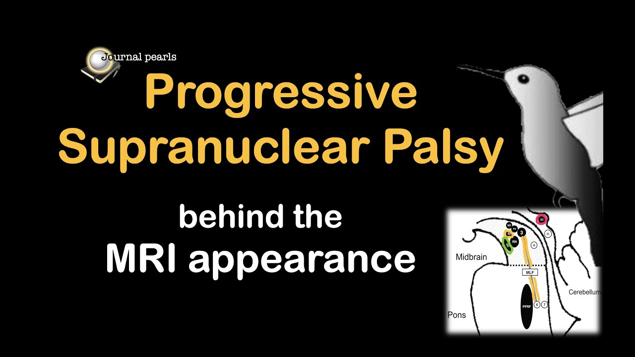 Progressive supranuclear palsy - understanding the signs on MRI