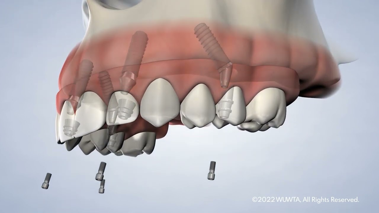 Full Arch with Dr. Koshgerian at The Oral Surgery & Dental Implant Specialists of San Diego