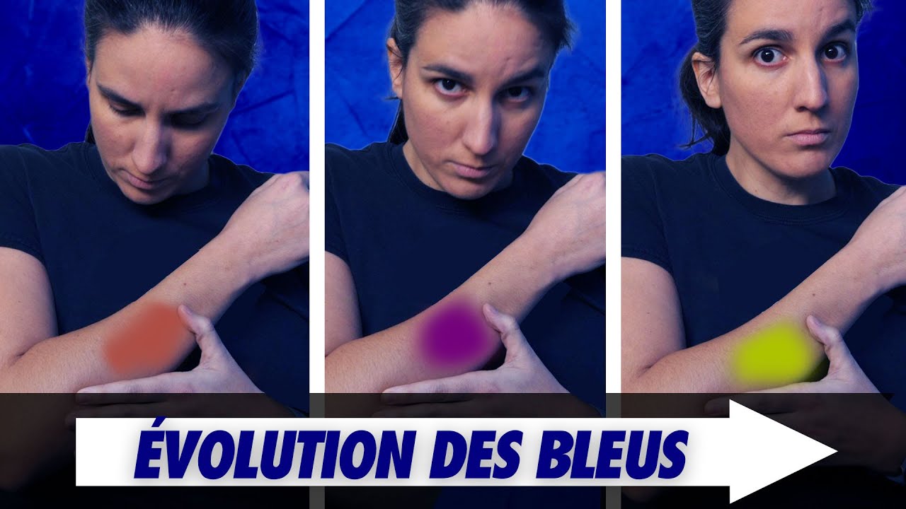 Pourquoi les ecchymoses changent de couleur ? Feat Primum Non Nocere