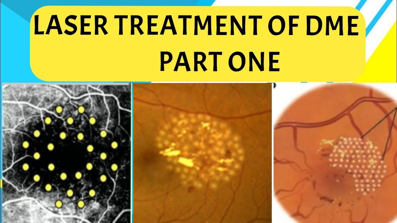 LASER TREATMENT for DIABETIC MACULAR EDEMA - PART 1 focal, grid, modified grid laser and more ..