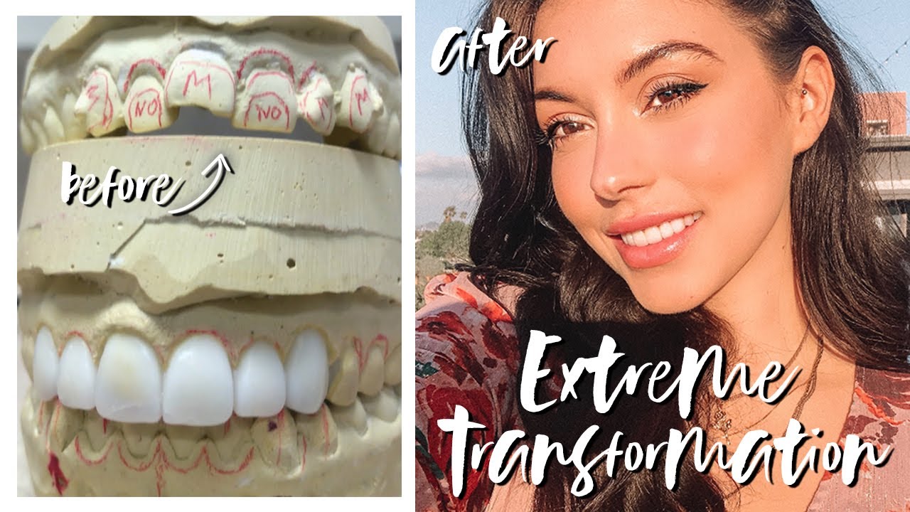 MY EXTREME SMILE TRANSFORMATION | GETTING PORCELAIN VENEERS! // ELLEKAE