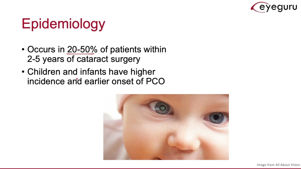 1.5: Posterior Capsular Opacifications