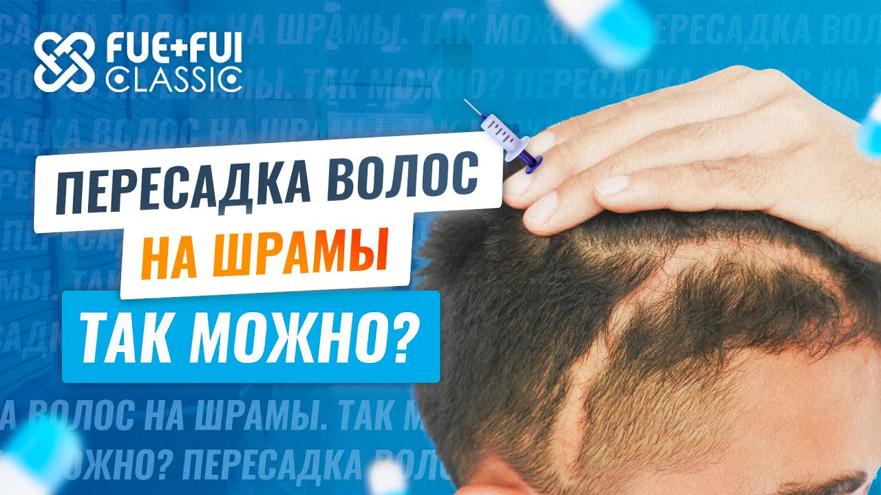 Пересадка волос на шрамы: особенности процедуры