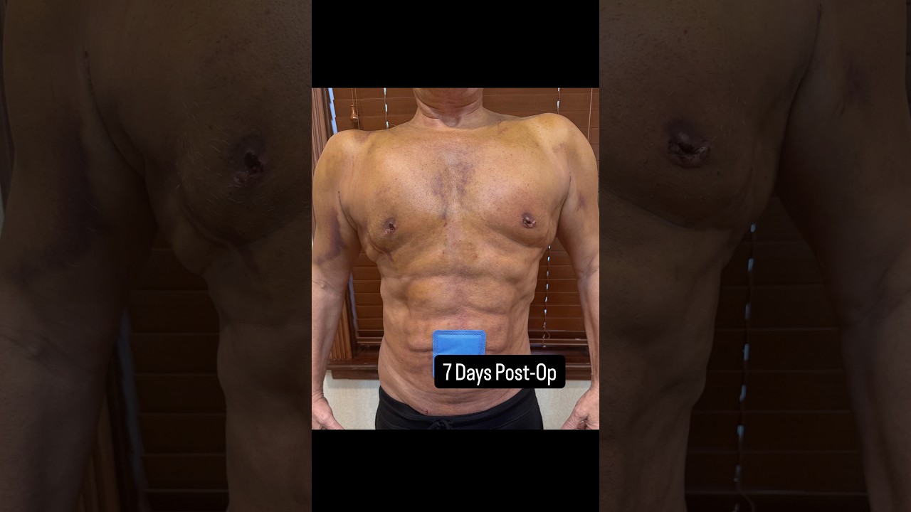 Pre-Op/3 Days Post-Op/7 Days Post-Op Results 