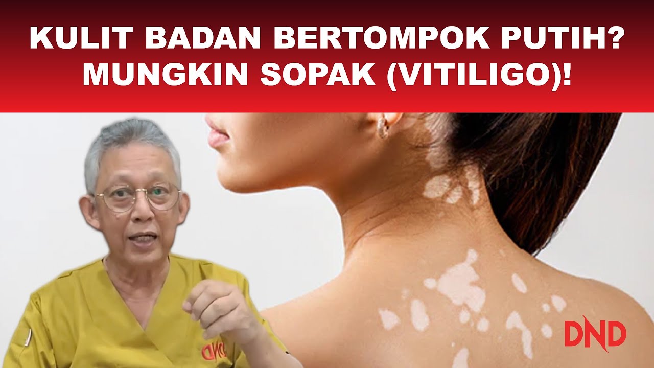 Bayangkan anda kena sopak (vitiligo). Kulit muka & badan bertompok putih & merebak! Bagaimana?