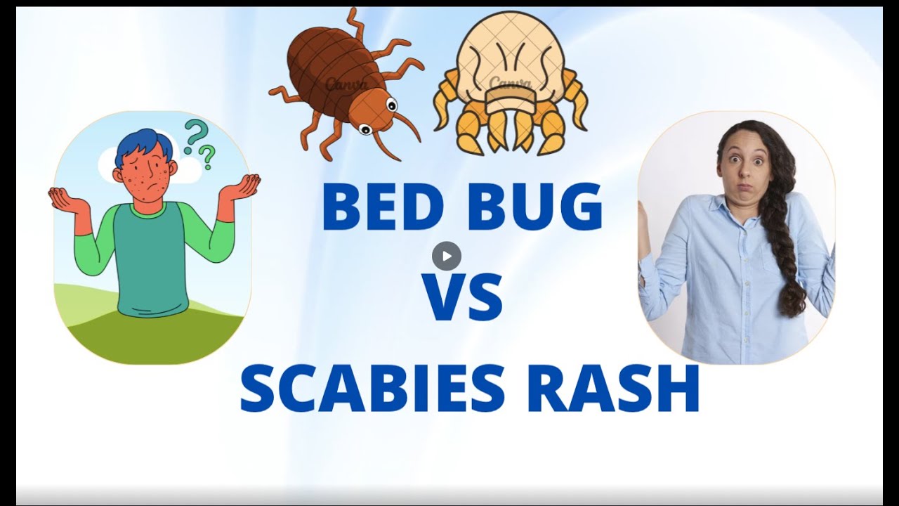 Bed Bug vs Scabies Rashes - Know the differences