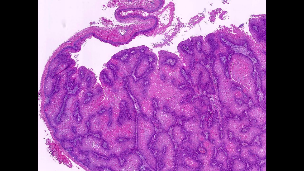 Benign epidermal neoplasms Part 2 (including cysts)