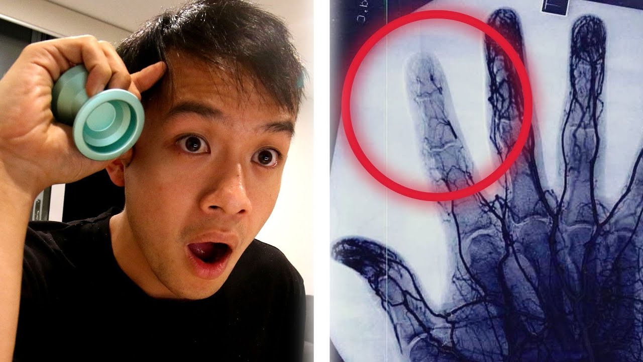 Hands After 10 Years Of Competitive Yoyoing