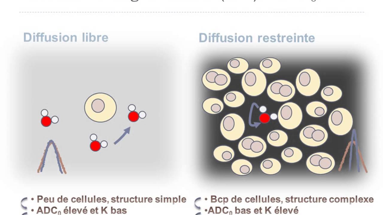 La diffusion dans tous ses états en imagerie du sein ADC, IVIM, Kurtosis
