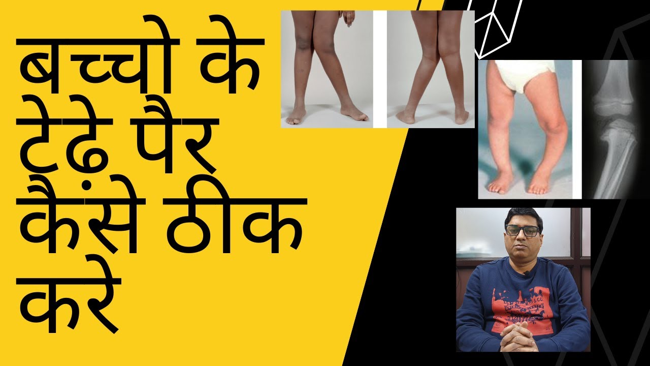 बच्चो के टेढ़े पैर कैसे ठीक करे /Dr. Pradeep Kumar Singh