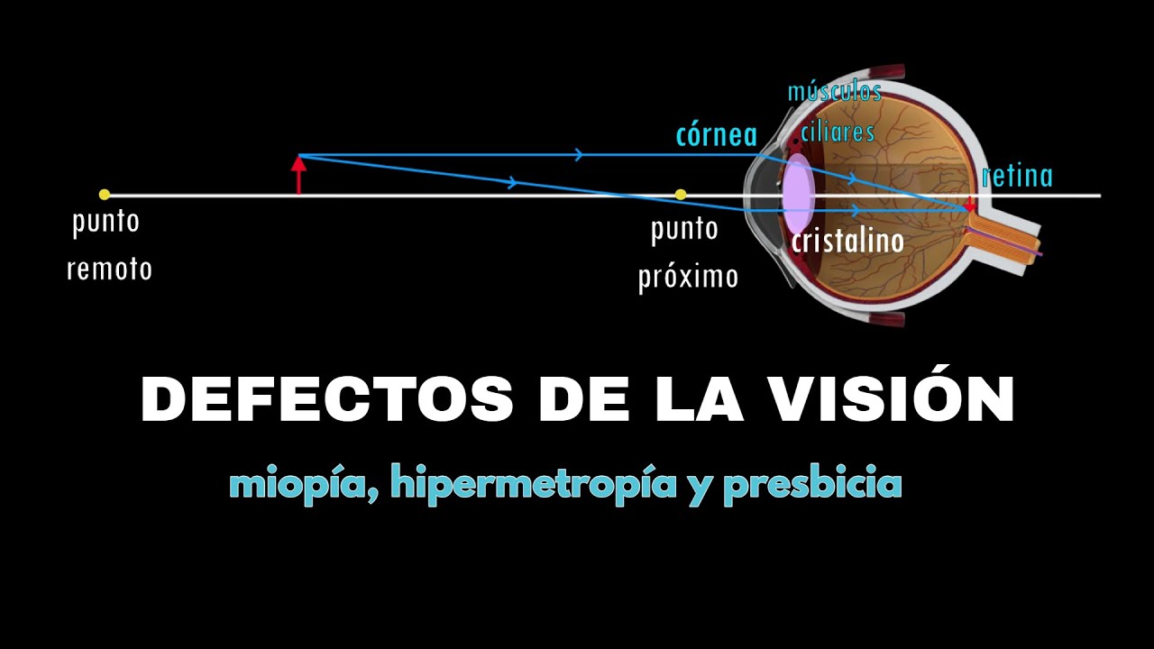Defectos de la visión: miopía, hipermetropía y presbicia. Óptica. Bachillerato. Ejercicios resueltos