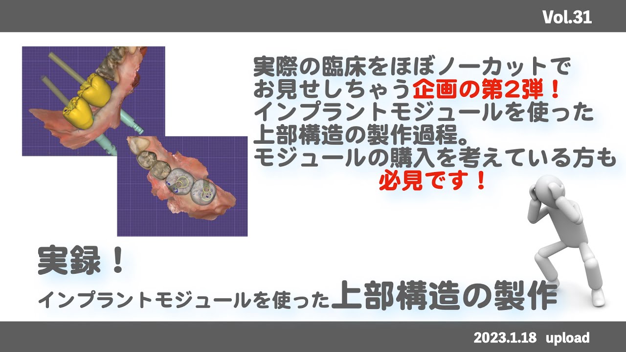 【exocad】実録！インプラント上部構造製作
