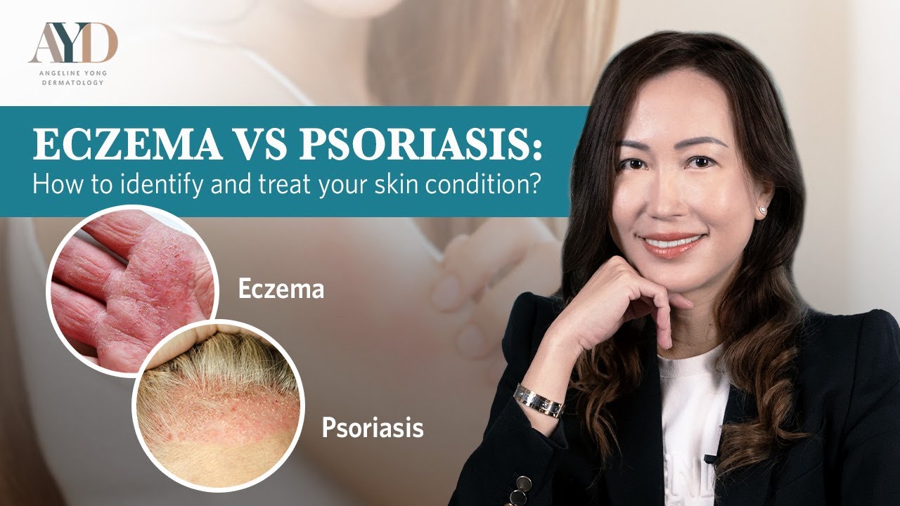 Understanding Eczema and Psoriasis: How to Identify and Manage Your Skin Condition