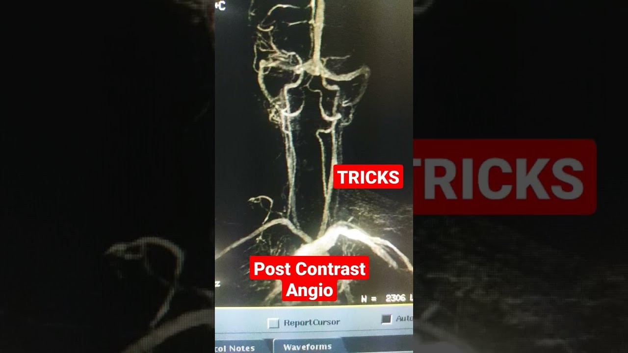 MRI Post Contrast Angio by TRICKS #shorts #viral
