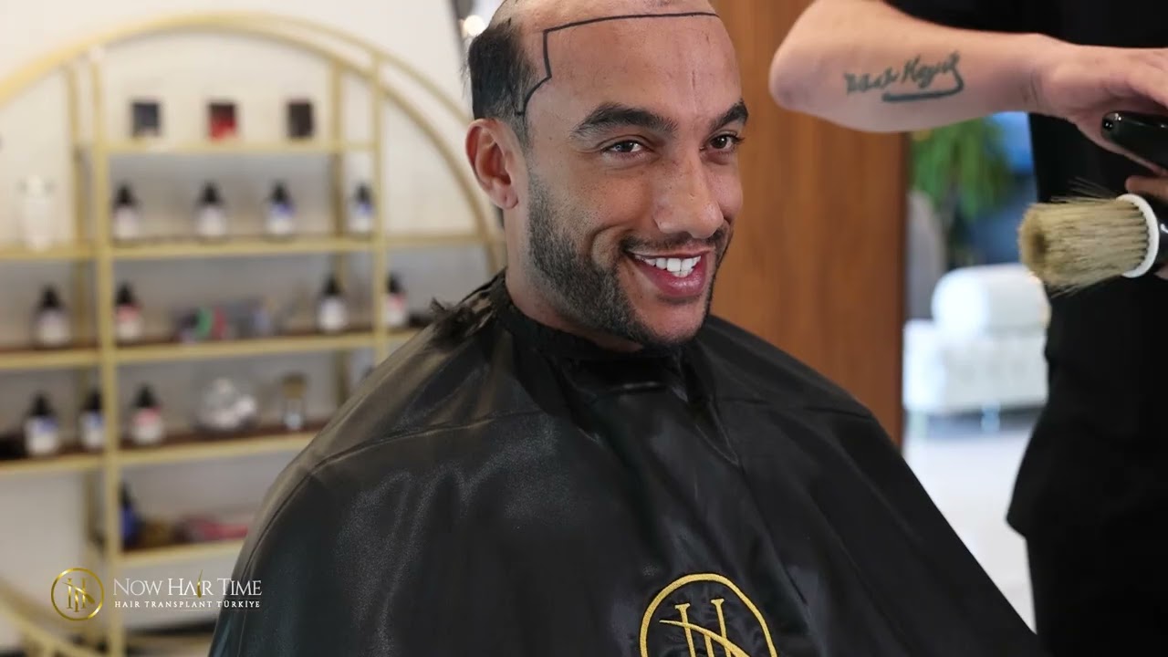 Afro Hair Transplant: High quality and Professional Service