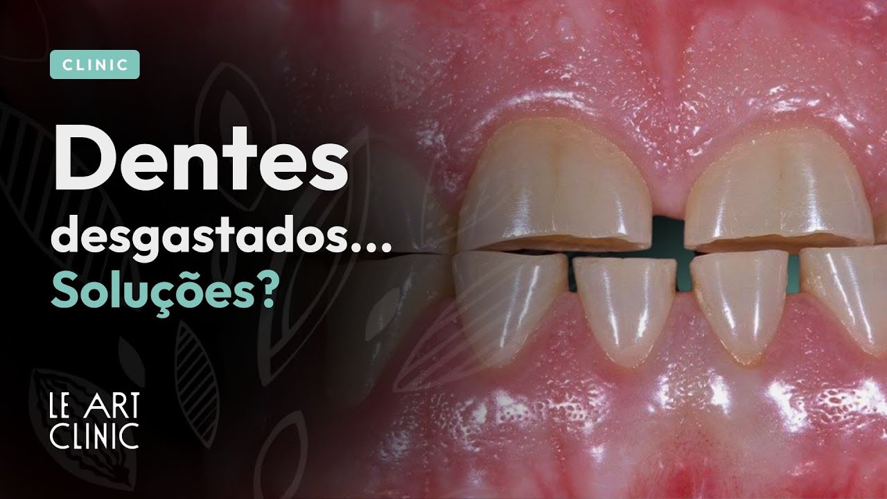 Dentes desgastados? Conheça as soluções disponíveis!