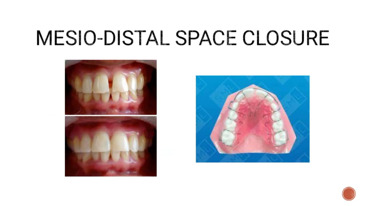 Removable Appliances 1#dentistry#orthodontic
