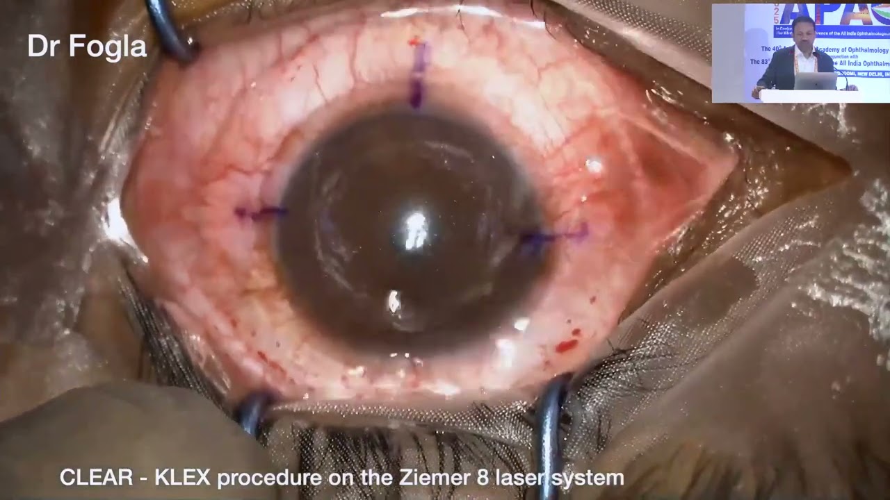 AIOS2025 GP219 T Dr Rajesh FOGLA CLEAR &ndash; A New Frontier in Lenticule Extraction