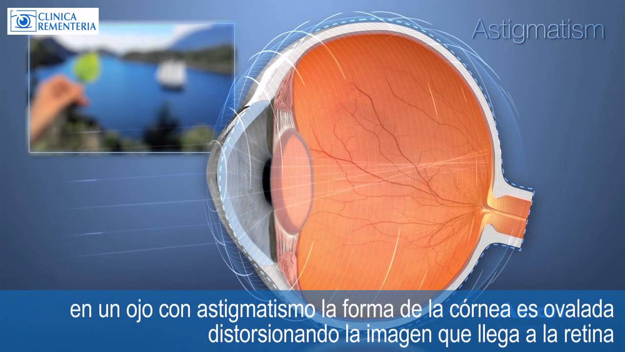 Astigmatismo | OptiLASIK cirugía refractiva 100% láser