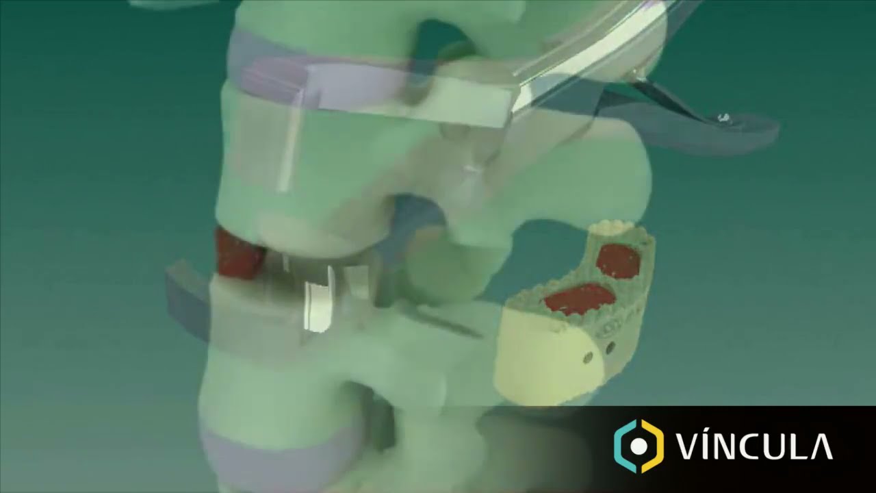 MDT Group (VINCULA): TLIF Cage