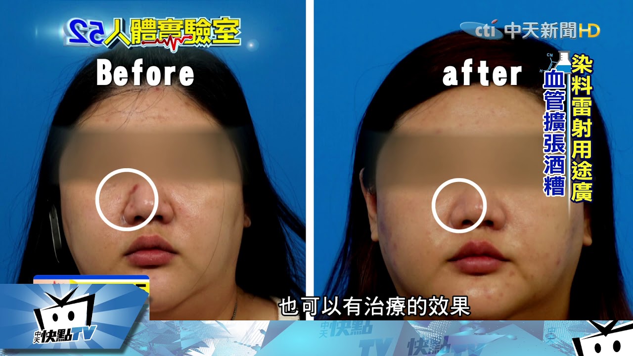 20170921中天新聞　人體實驗室　紅豆疤血管絲掰掰　染料雷射照一照