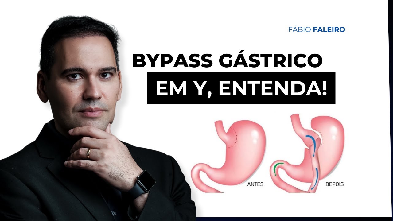 BYPASS GÁSTRICO EM Y - Entenda como funciona o BYPASS GÁSTRICO EM Y!