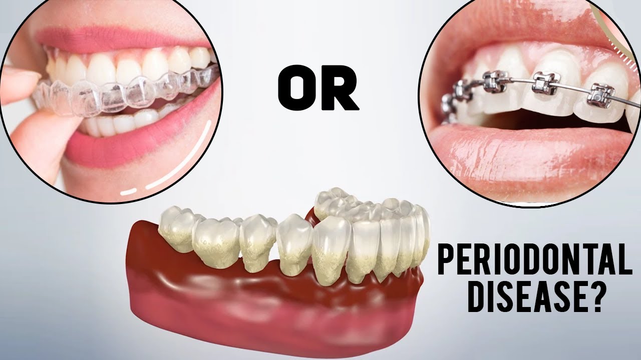 Periodontal Disease and Invisalign, Braces or ClearCorrect