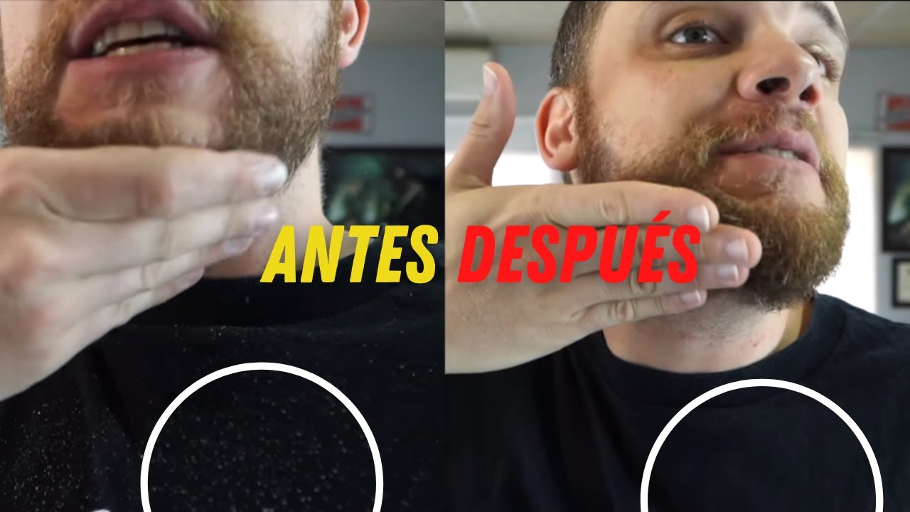 ¿CÓMO QUITAR LA CASPA DE LA BARBA? // DESCAMACIÓN EN LA BARBA