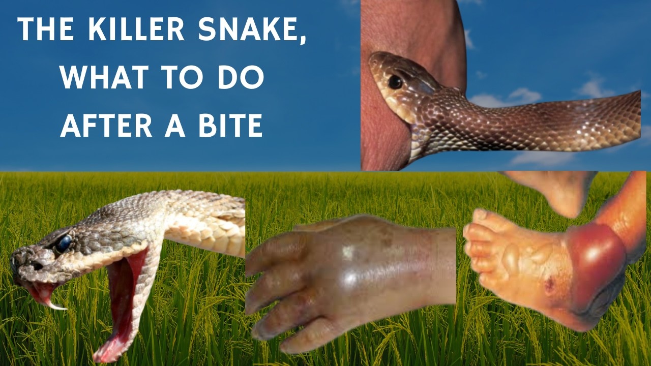 Snake bite, everything you need to know