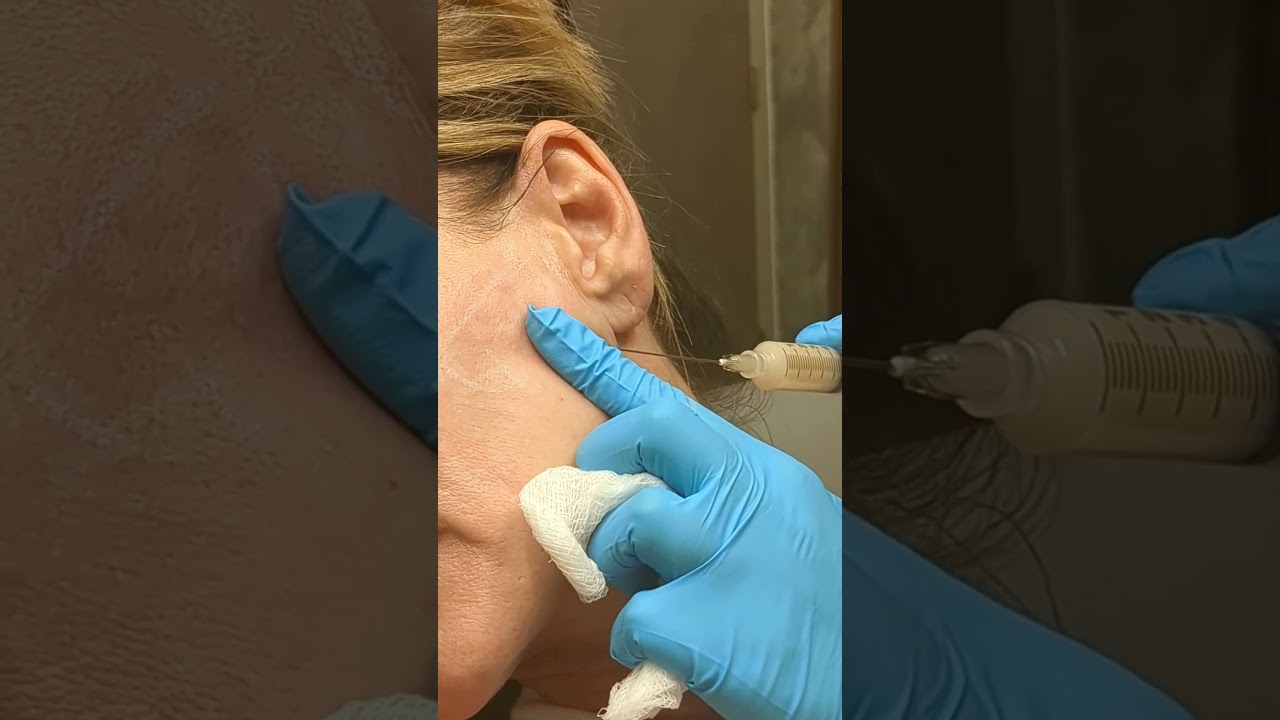 Renuva: Fast, Long-Lasting Volume