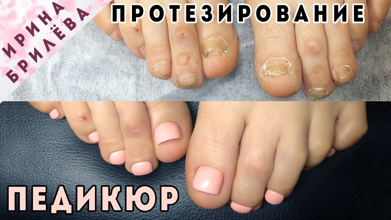 Сложный ПЕДИКЮР 👣 Укрепление ногтей полигелем