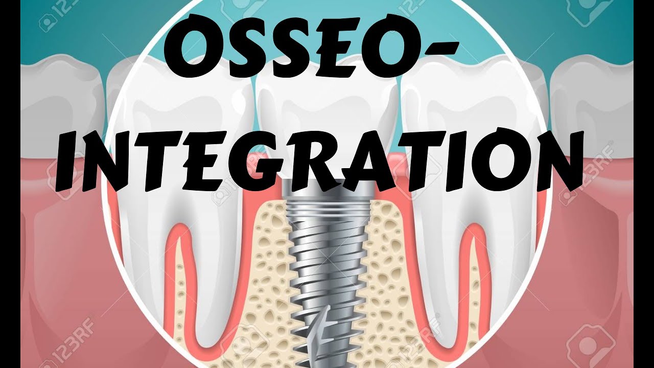 Osseointegration- Principle, Mechanism & factors  (Branemark prosthesis)- Dental implant lecture
