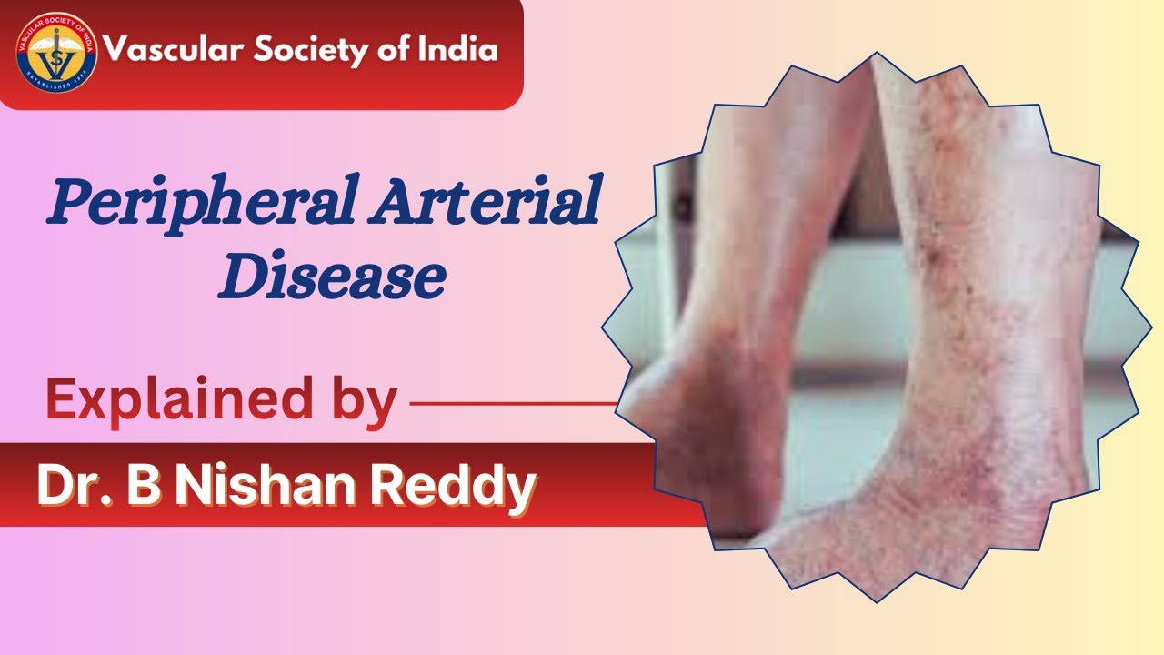 Peripheral Arterial Disease (PAD) Explained | Symptoms, Causes & Treatment | Dr. B Nishan Reddy