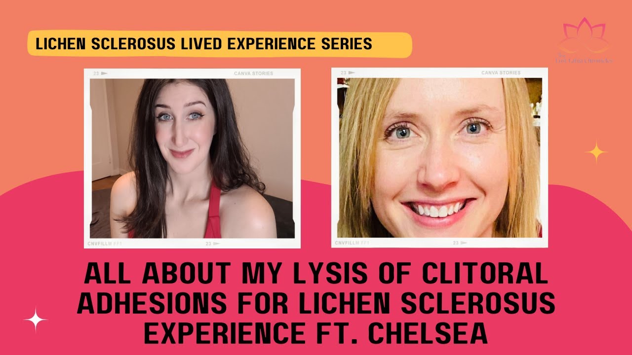 All About My Lysis of Clitoral Adhesions for Lichen Sclerosus Experience ft. Chelsea
