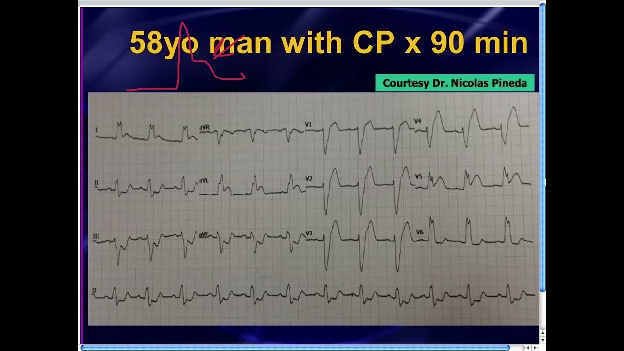 Mattu ECG Case_ April 1, 2013