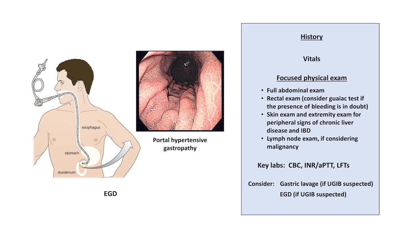 An Approach to GI Bleeding (Melena, Hematemesis, Hematochezia)