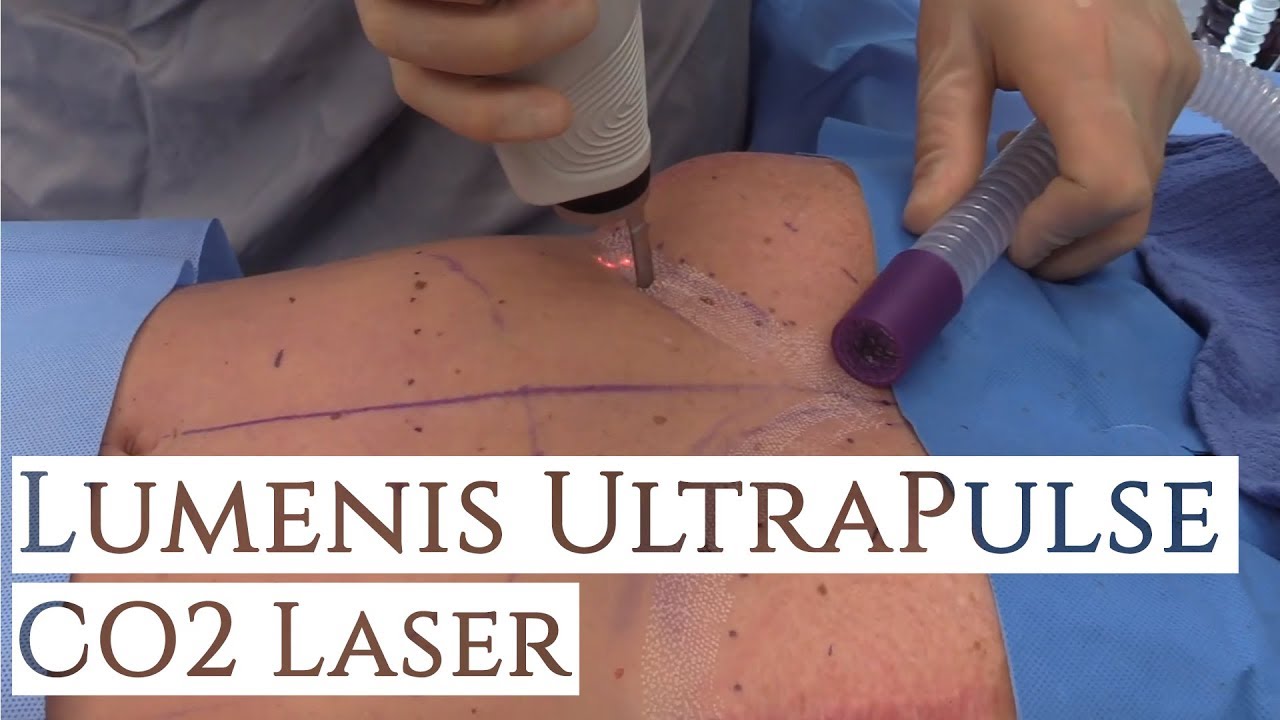 Lumenis UltraPulse CO2 Laser| Fractional Laser Resurfacing | Los Angeles | Facial Rejuvenation