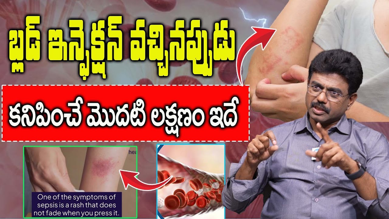 బ్లడ్ ఇన్ఫెక్షన్ వచ్చినప్పుడు కనిపించే మొదటి లక్షణం ఇదే! | Blood Infection Symptoms | Dr V. Rajesh