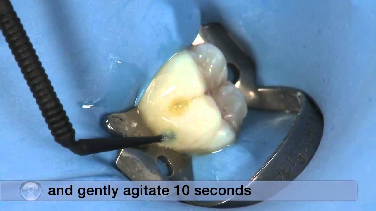 Peak Universal Bond - Ultradent