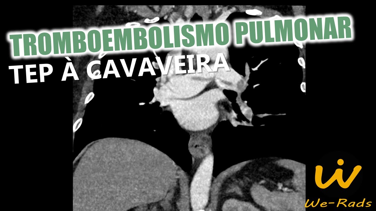 Tromboembolismo pulmonar (TEP) à cavaleira na tomografia e angiotomografia arterial de tórax