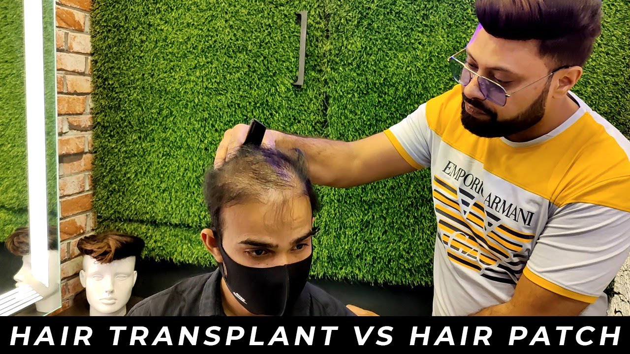 Hair transplant vs hair patch | hair patch tapping | hair patch in delhi #hairpatch