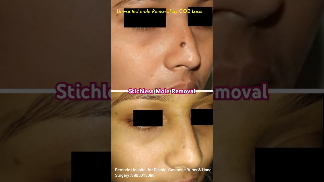 Stichless & Scarless Mole Removal Using CO2 Laser having Best Cosmetic Results with Painless Method